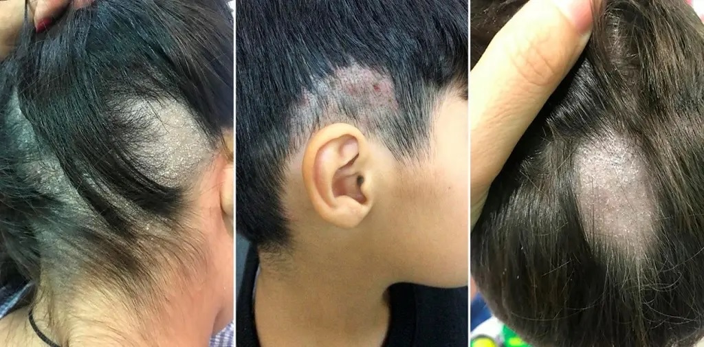 Definen como epidemia la proliferación de un hongo en las peluquerías