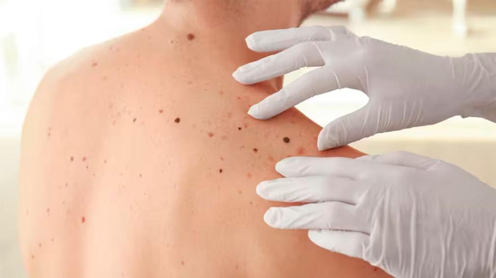 CANCER DE PIEL: La vacuna argentina para el melanoma estaría disponible desde marzo
