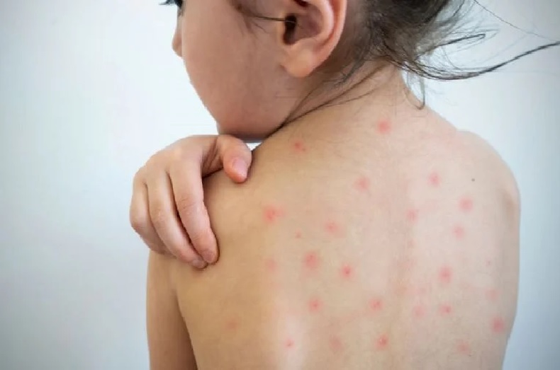 Ya son 13 casos confirmados de sarampión en el AMBA