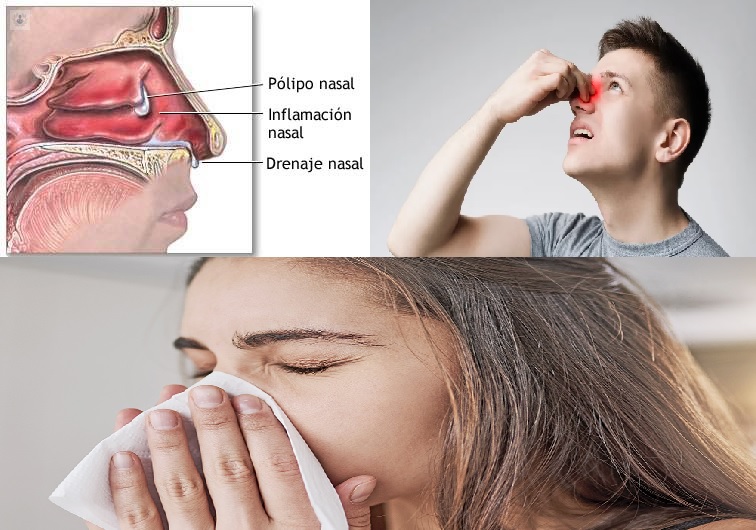 Poliposis nasal, la enfermedad inflamatoria que aparece con el clima otoñal