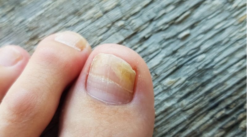 Conoce el truco para evitar el dolor de las uñas encarnadas
