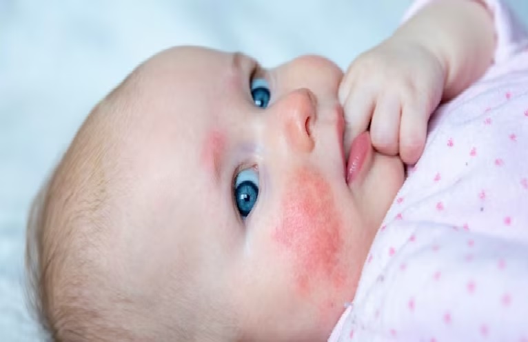 Qué es el Virus de la bofetada, la enfermedad contagiosa que afecta a los chicos