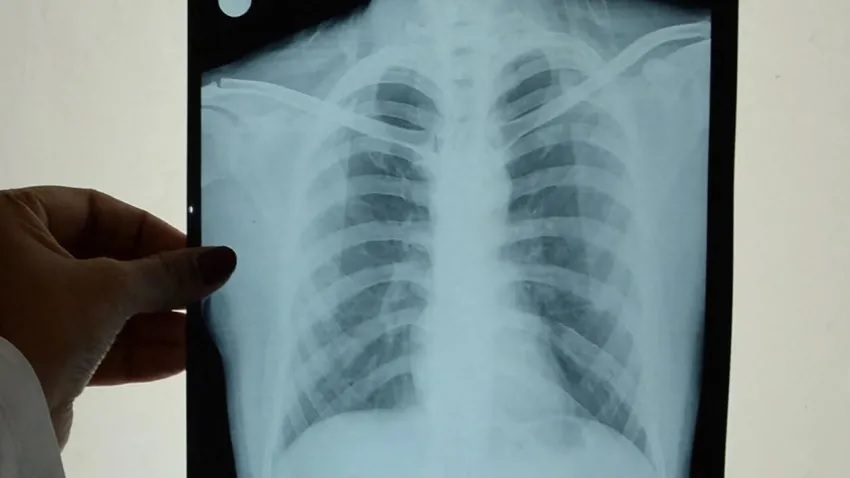 Los casos de tuberculosis aumentan un 38% en Argentina
