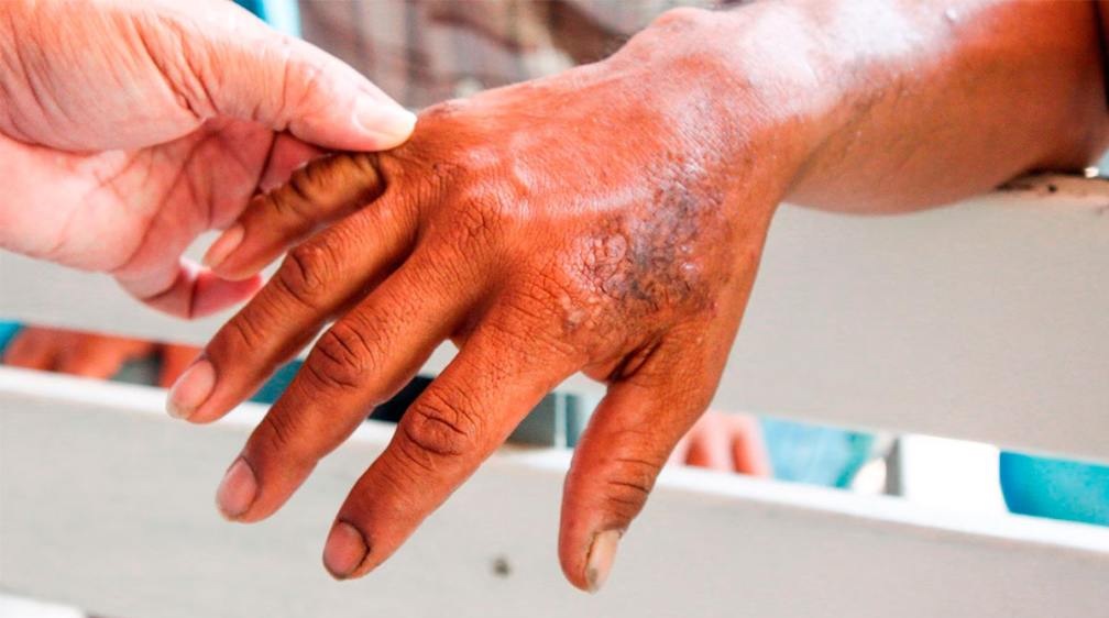 México en alerta: ya son 300 los casos de lepra