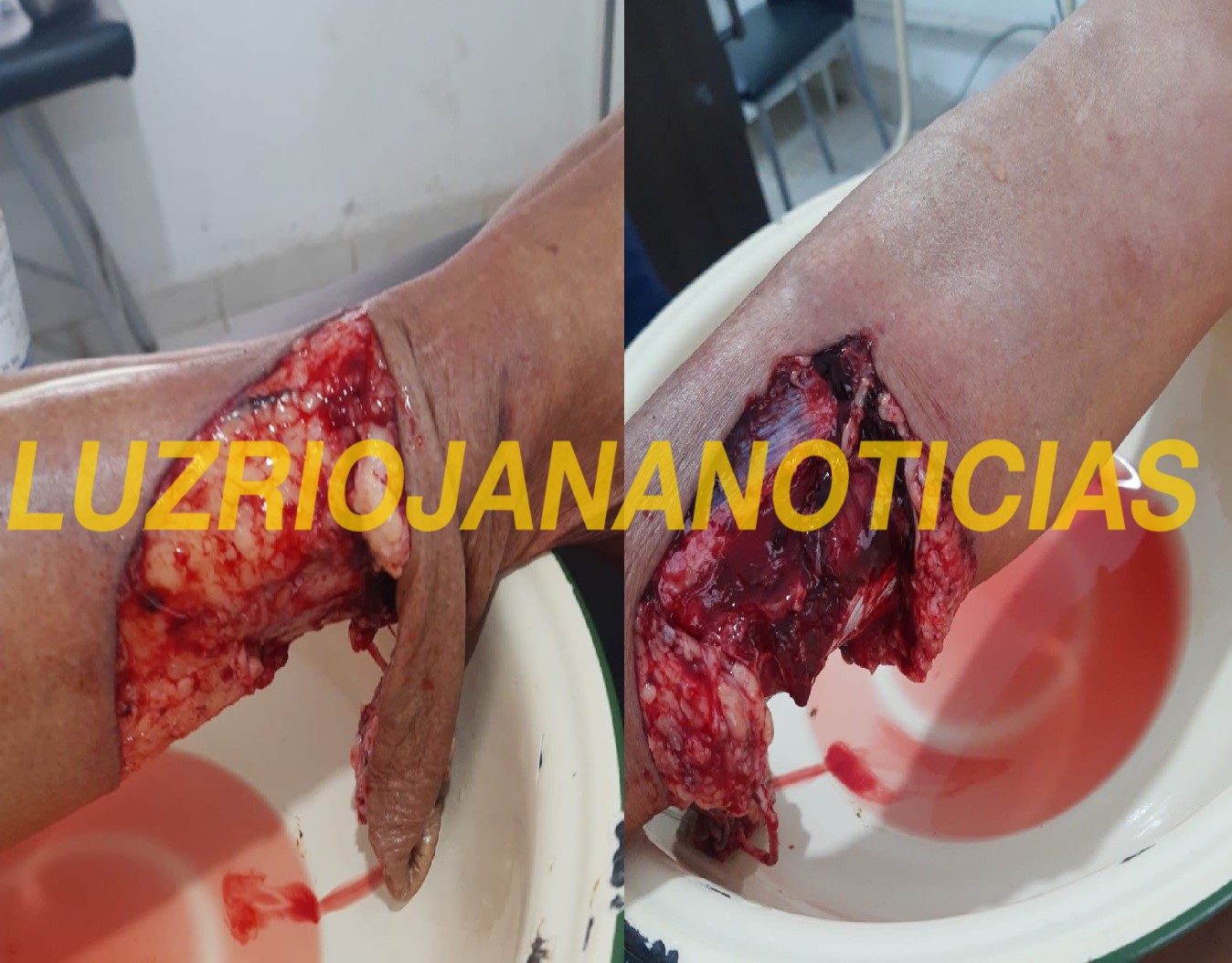 NONOGASTA: DOS PIT BULL ATACARON A UNA ABUELA DE 74 AÑOS