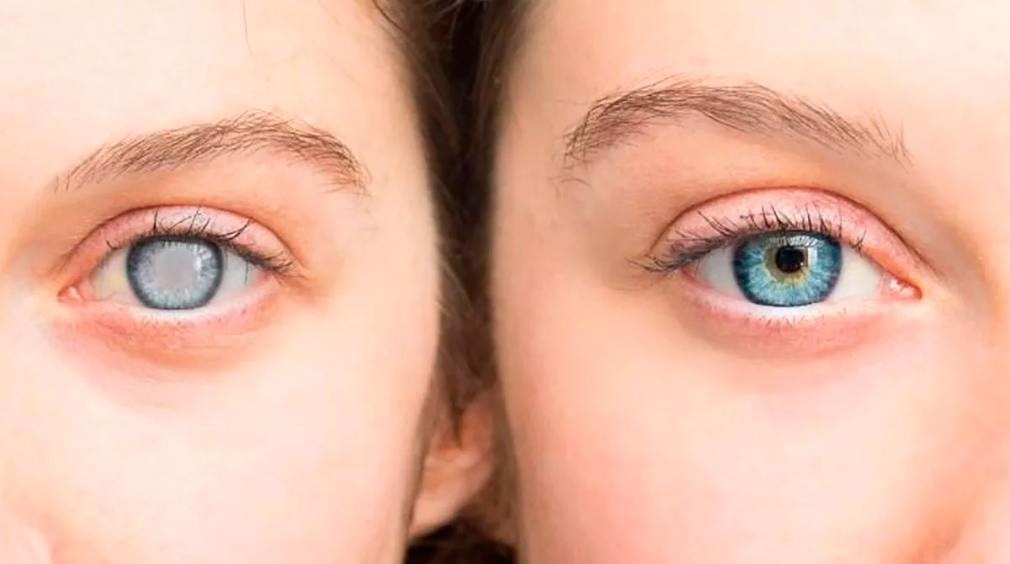 CATARATAS: ¿Cuáles son sus síntomas?