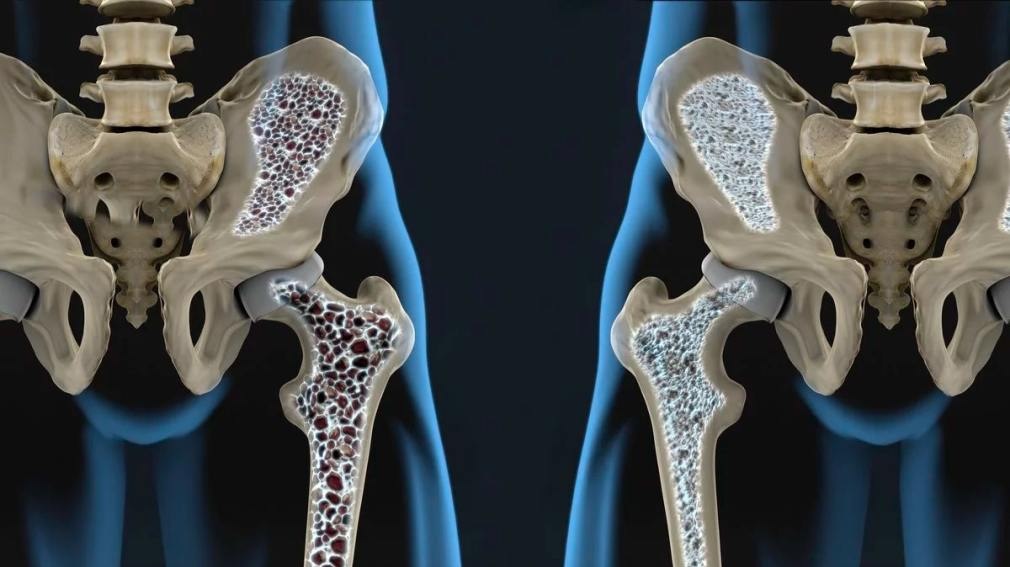 Uno de cada cinco varones puede fracturarse por osteoporosis luego de los 50 años