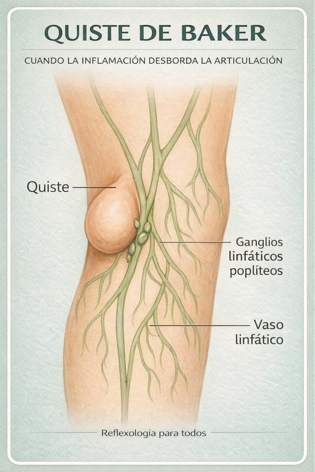 Quiste de Baker (quiste popl&iacute;teo)