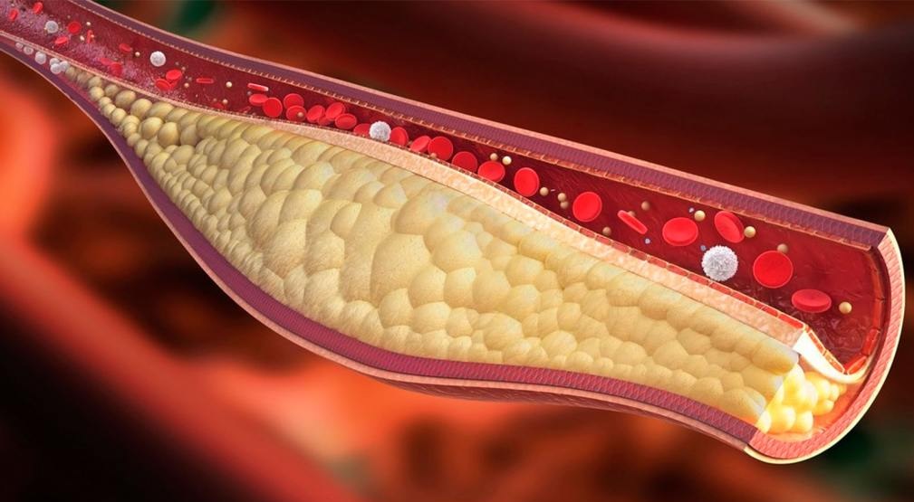 Prevenci&oacute;n de infartos y ACV: publicaron las nuevas gu&iacute;as con los valores de colesterol ideales