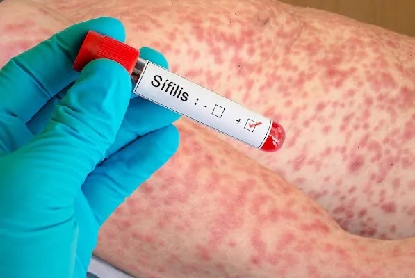 LA RIOJA: Preocupaci&oacute;n por el aumento de s&iacute;filis,&ldquo;Hay un cambio de h&aacute;bitos en los j&oacute;venes&rdquo;